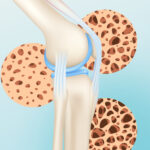 Що+таке+остеопороз+кісток_850x350