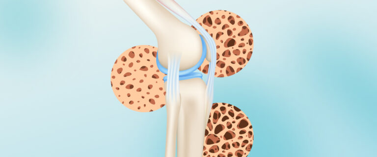 Що+таке+остеопороз+кісток_850x350